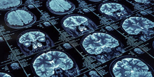 Intraoperative Neuro Monitoring